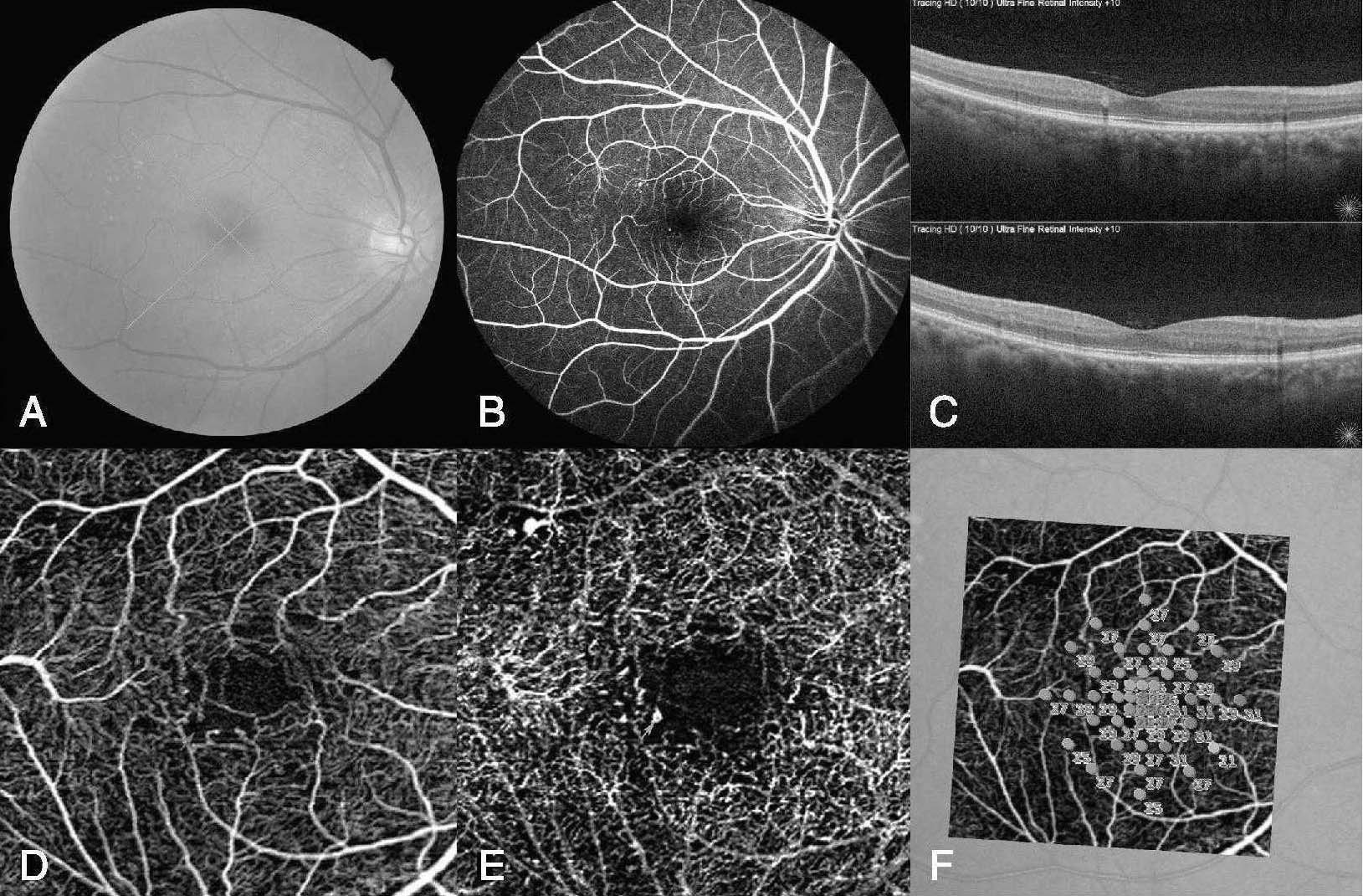 视网膜血管性疾病——8、黄斑中心凹旁毛细血管扩张症 - 知乎